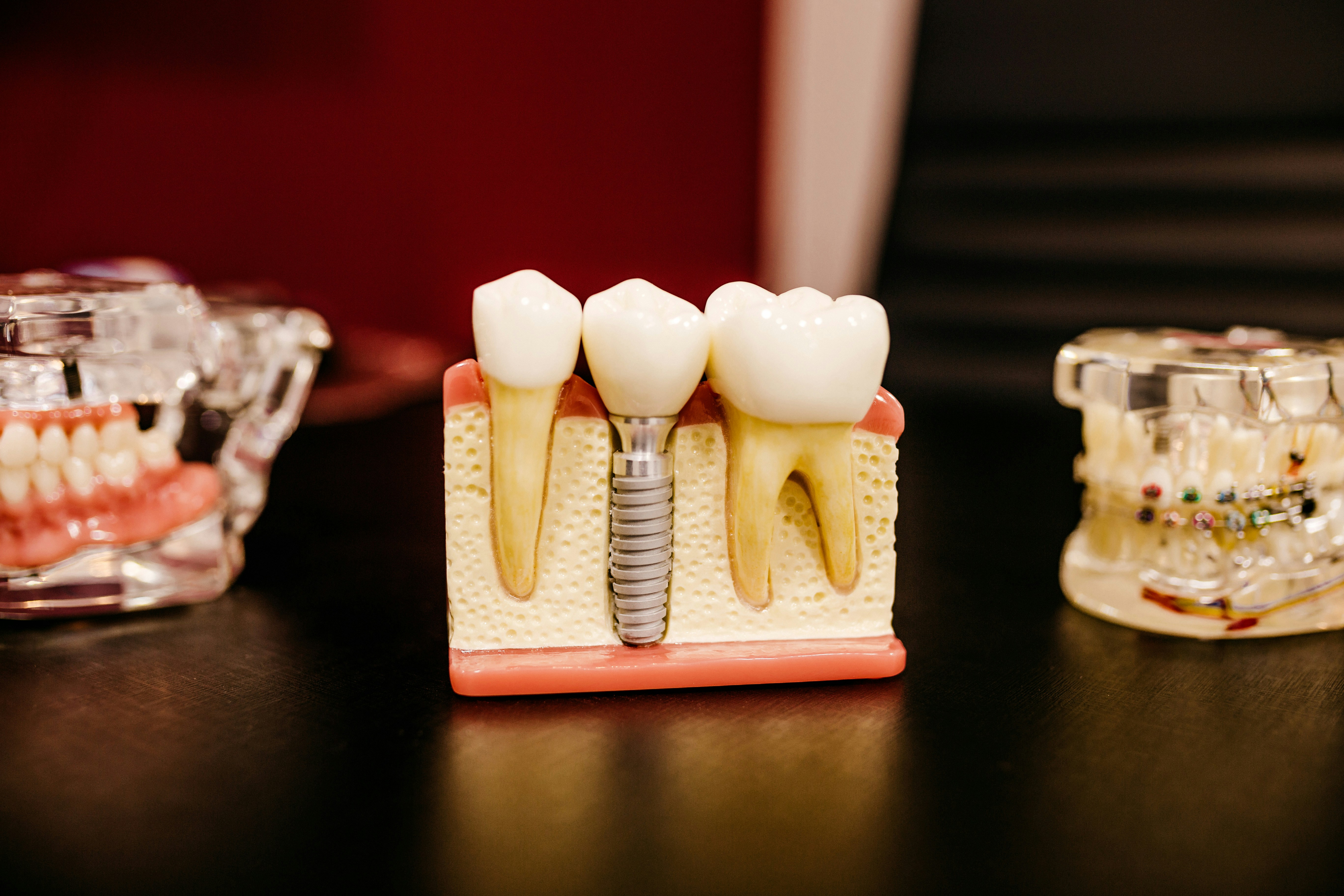 Single-Tooth Implants: A Simple, Permanent Fix