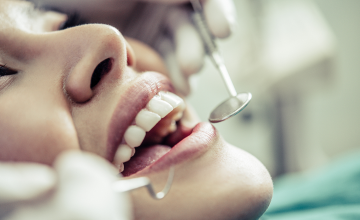 Teeth Whitening